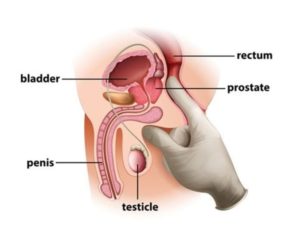 Prostate Examination and milking the prostate